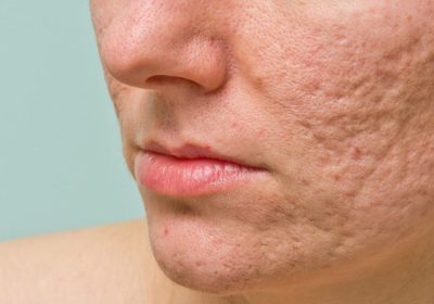Get Rid From The Acne Scar In Veanna Clinic