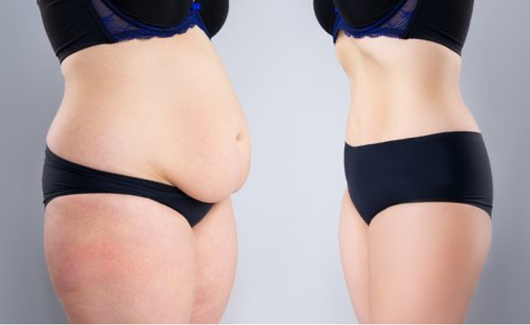 Your Guide To Panniculectomy Surgery Aka Extra Skin Removal Procedure Wellness Phx 