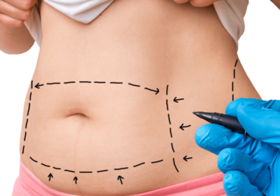 An Overview of Tummy Tucks: All the Information You Need to Know