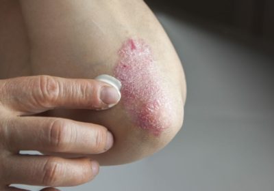 Always check out treatments for psoriasis skin diseases