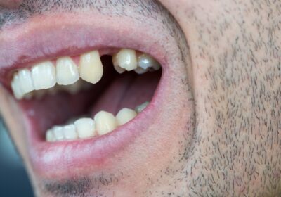 Five options for replacing a missing tooth