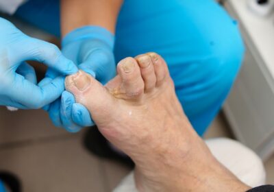 How Can You Stop Foot and Toenail Fungus in Their Tracks?
