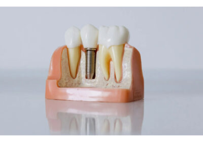 The Role of Sedation Dentistry in Full Mouth Dental Implant Procedures