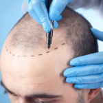 What Are the Long-Term Results of Hair Transplants and How Can I Maintain My New Hair Growth?