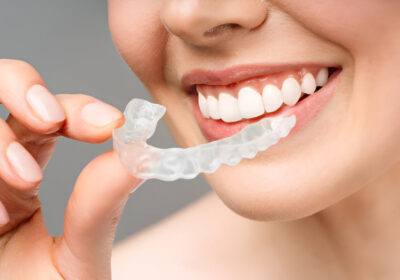 Mouth Guards Matter More than You Think