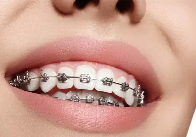Dental Hygiene with Braces