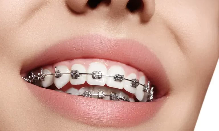 Braces