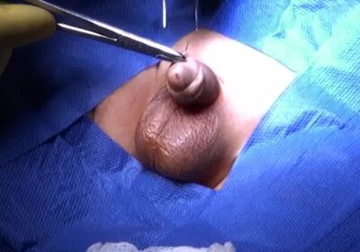 Penile Torsion Surgery: Understanding the Procedure and Results