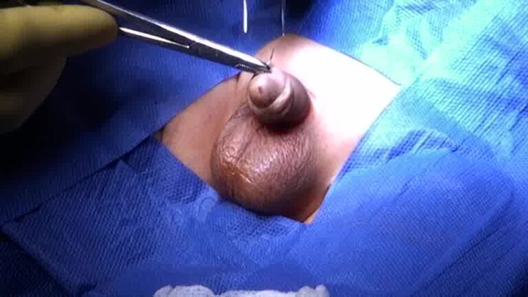Penile Torsion Surgery