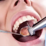 How Key Mask Dental Resins Are Revolutionizing Accuracy in 3D Printing