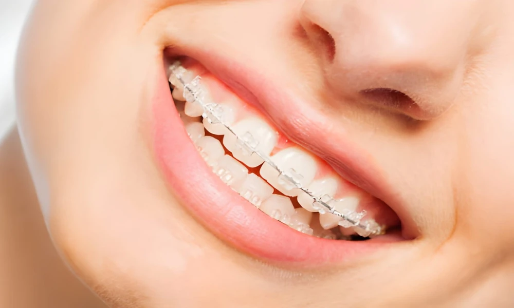 Ceramic vs Metal Braces: Which is Right for You?