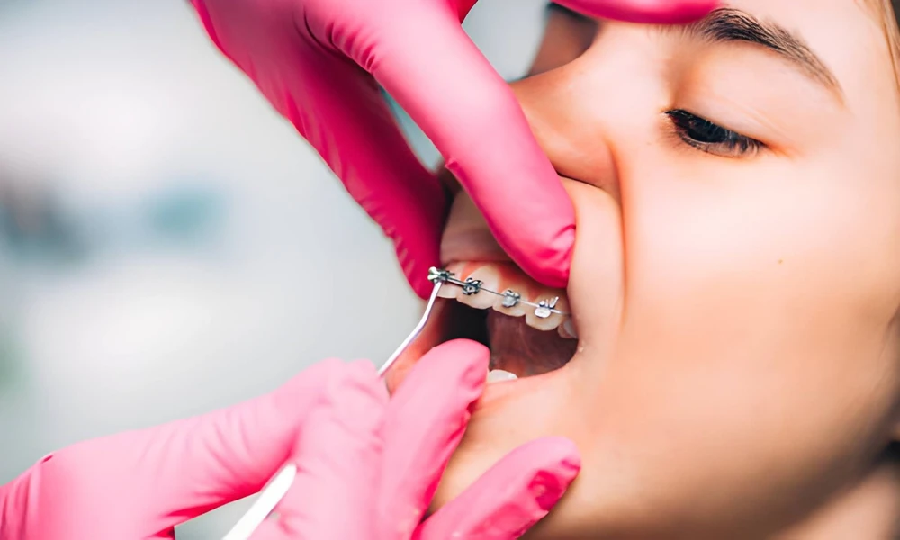 How Long Does It Take for MSE Palate Expansion to Show Results?